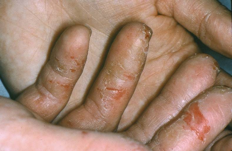 contact dermatitis fingers