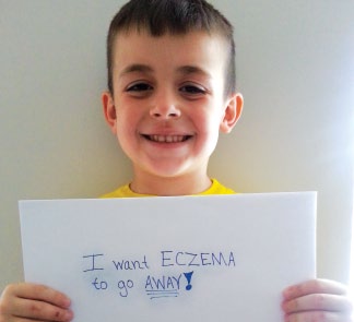 Eczema In Children National Eczema Association