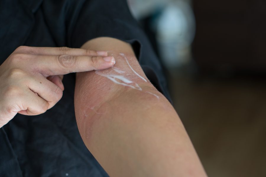 California dermatologist pioneers a simple, non-prescription treatment for atopic dermatitis