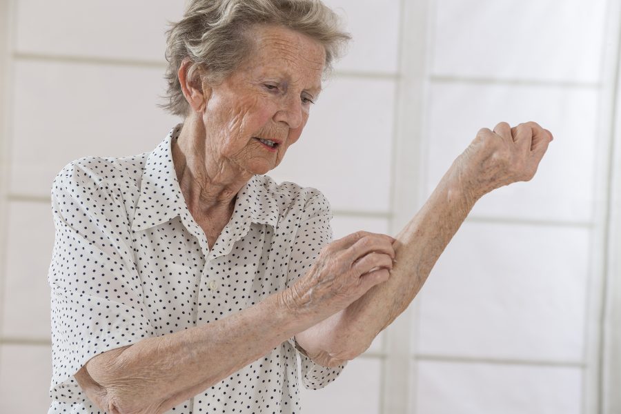 Atopic dermatitis in older adults is common, hard to treat