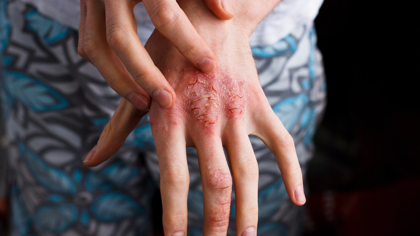 Types of eczema: atopic dermatitis