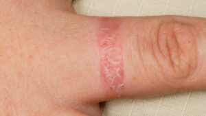 Contact Dermatitis: Causes, Symptoms And Treatment