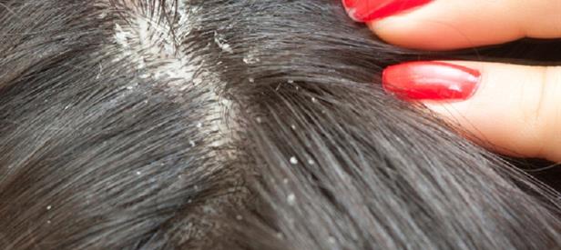 seborrheic dermatitis scalp african american hair