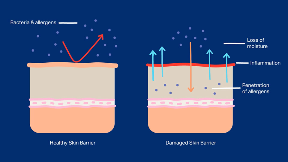 https://nationaleczema.org/wp-content/uploads/2021/09/SkinBarrierIllustration_Web_960x540.jpg?utm_source=chatgpt.com