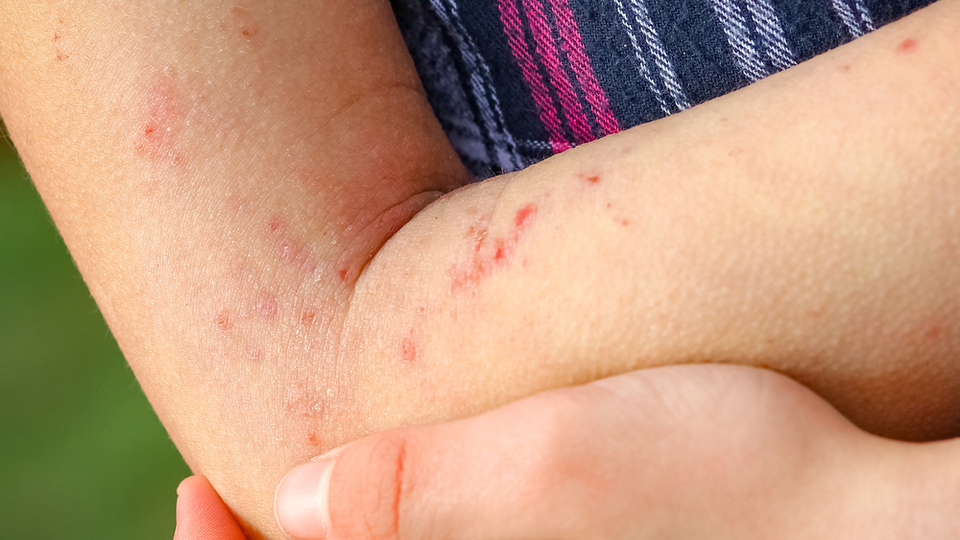 Pediatric Eczema What Every Parent Needs to Know National Eczema