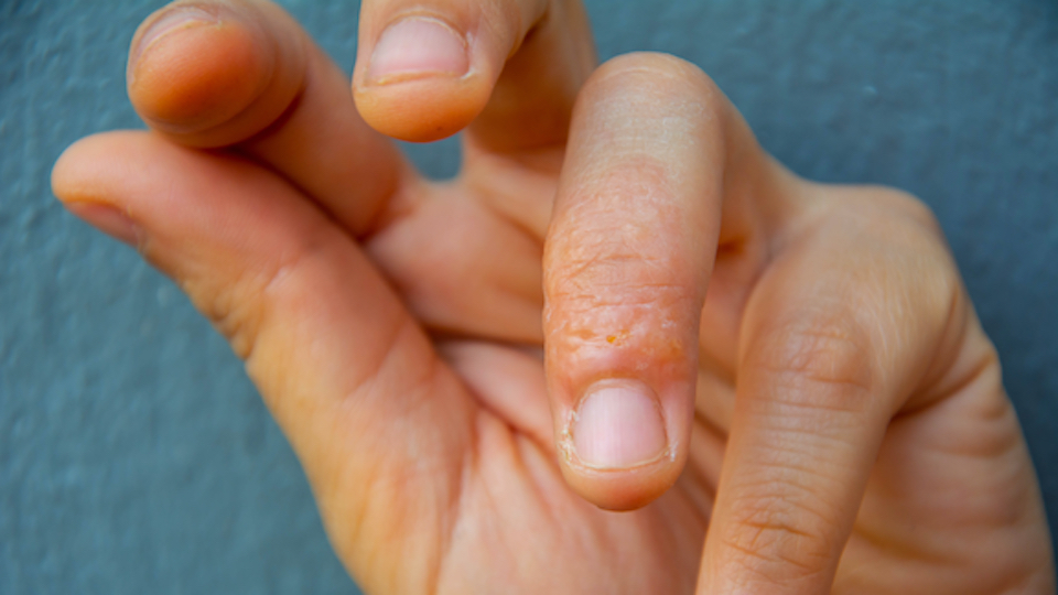 These Are the 7 Types of Eczema and Here's How to Tell Which One(s