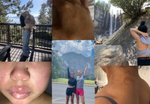 Brittany Masangkay living her life with eczema