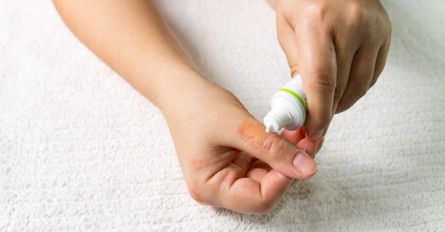 One hand squeezing ointment medication onto a rash on the other hand's thumb