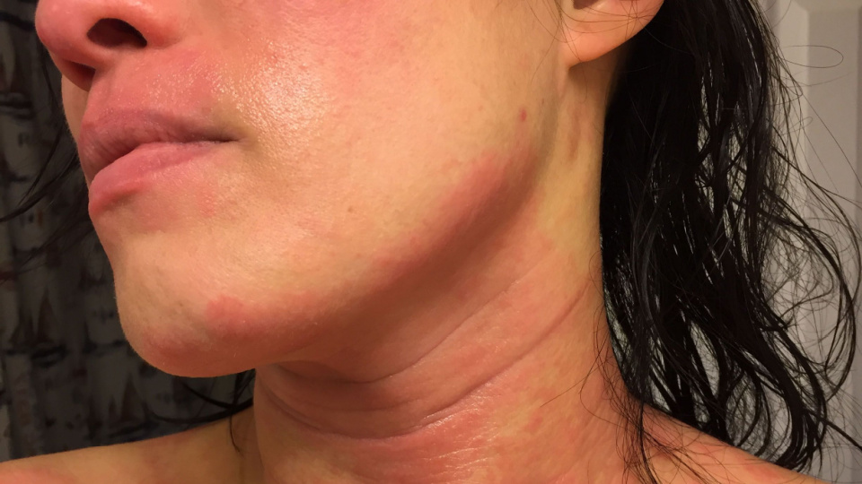 inar The Skinny on TSW and Steroids National Eczema Association