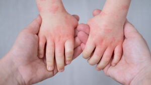 Close up of adult hands holding a child’s hands with red, irritated skin.