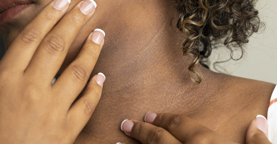 Eczema on Aisha's neck, framed by her hands.