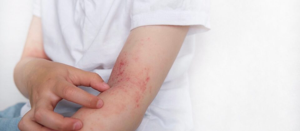 The child scratches atopic skin. Dermatitis, diathesis, allergy on the child's body.